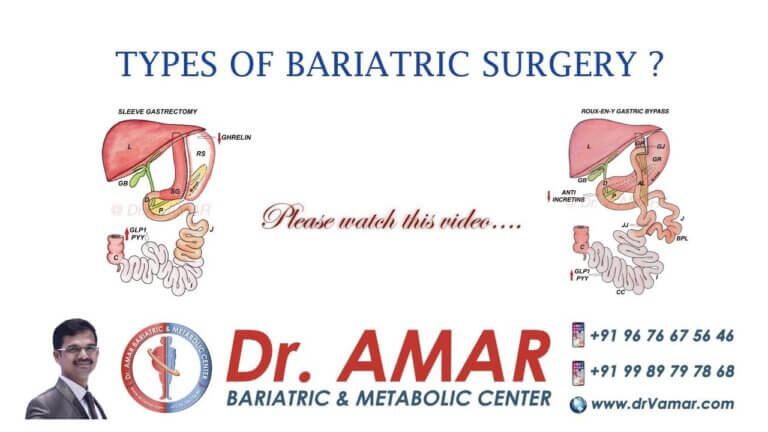 Types of Bariatric Surgeries