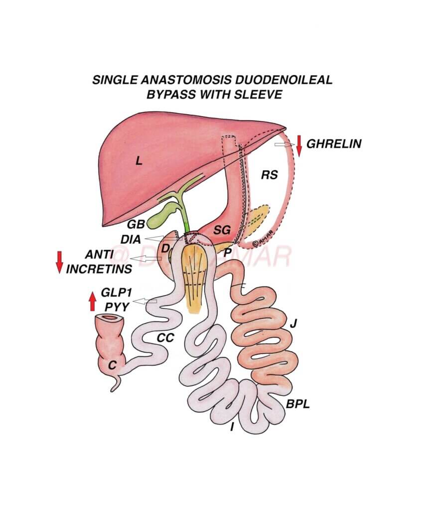 Metabolic Surgery - Dr. V Amar