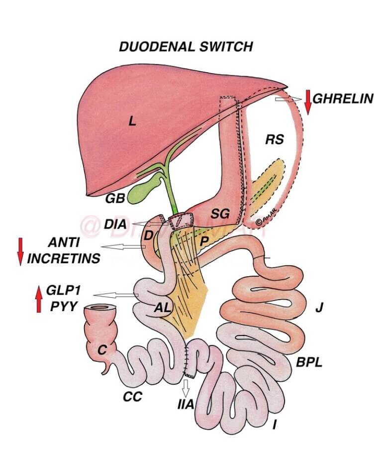 ROBOTIC, LAPAROSCOPIC BILIOPANCREATIC DIVERSION WITH DUODENAL SWITCH ...